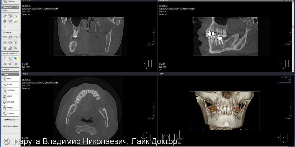 Установка имплантов Nobel Parallel в боковом отделе, 53 года, до и после - фото №2