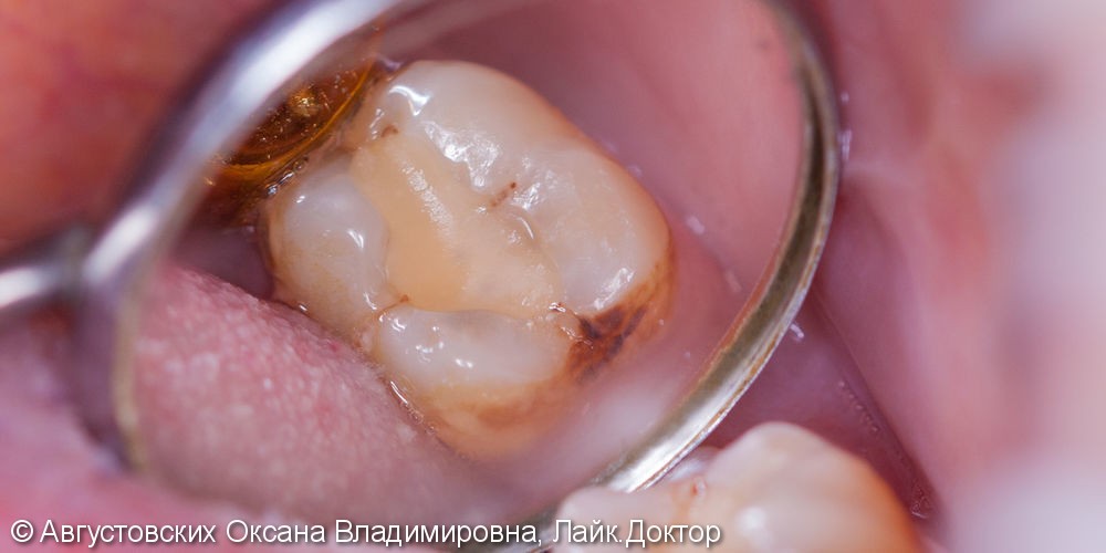 Лечение кариеса жевательного зуба, до и результат после - фото №1