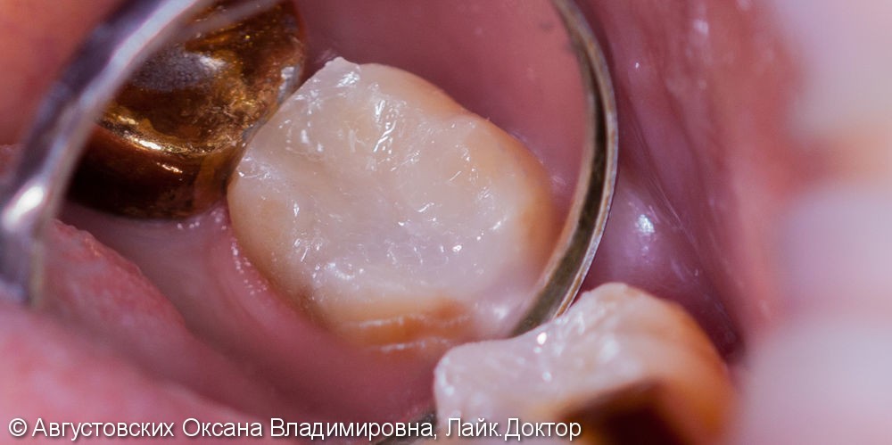 Лечение кариеса жевательного зуба, до и результат после - фото №2