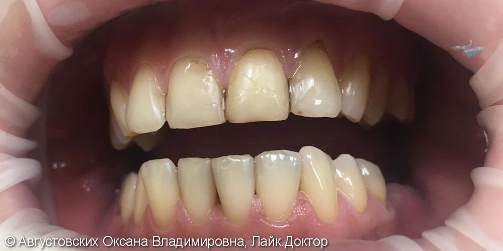 Реставрация двух передних зубов - фото №1