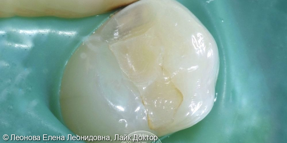 Плановая санация перед ортодонтическим лечением - фото №1
