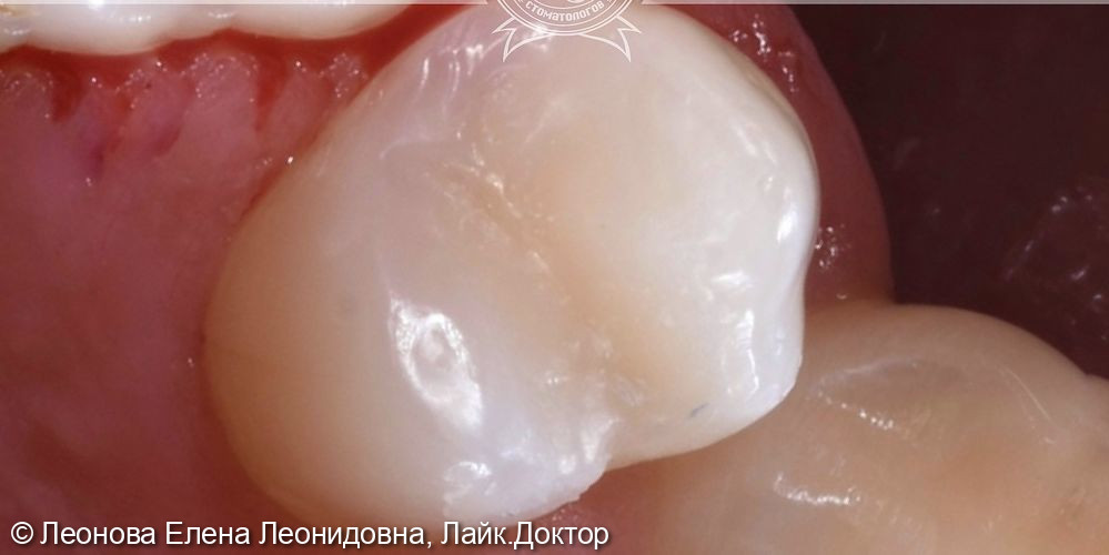 Плановая санация перед ортодонтическим лечением - фото №2