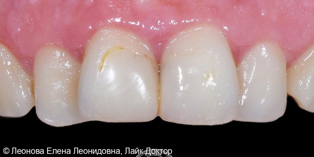 Пациентка обратилась в клинику с целью плановой санации перед ортодонтическим лечением - фото №1