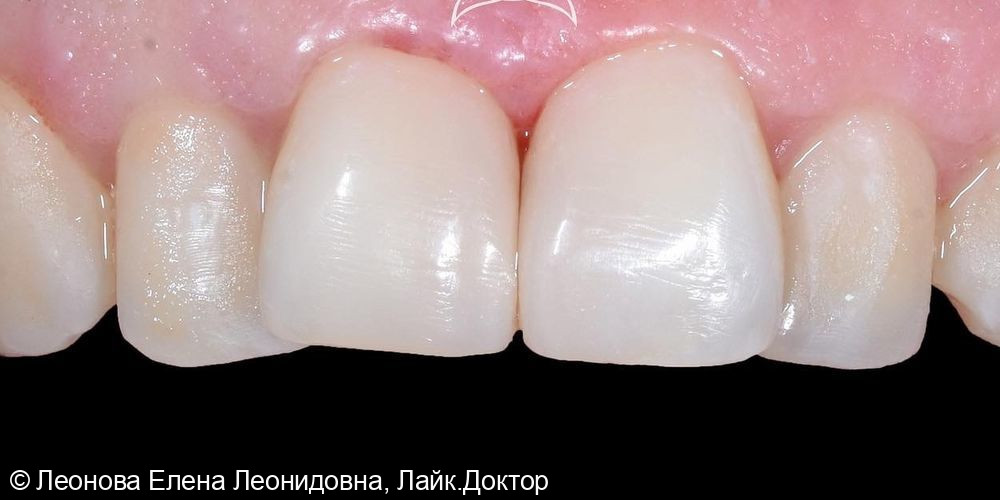Пациентка обратилась в клинику с целью плановой санации перед ортодонтическим лечением - фото №2