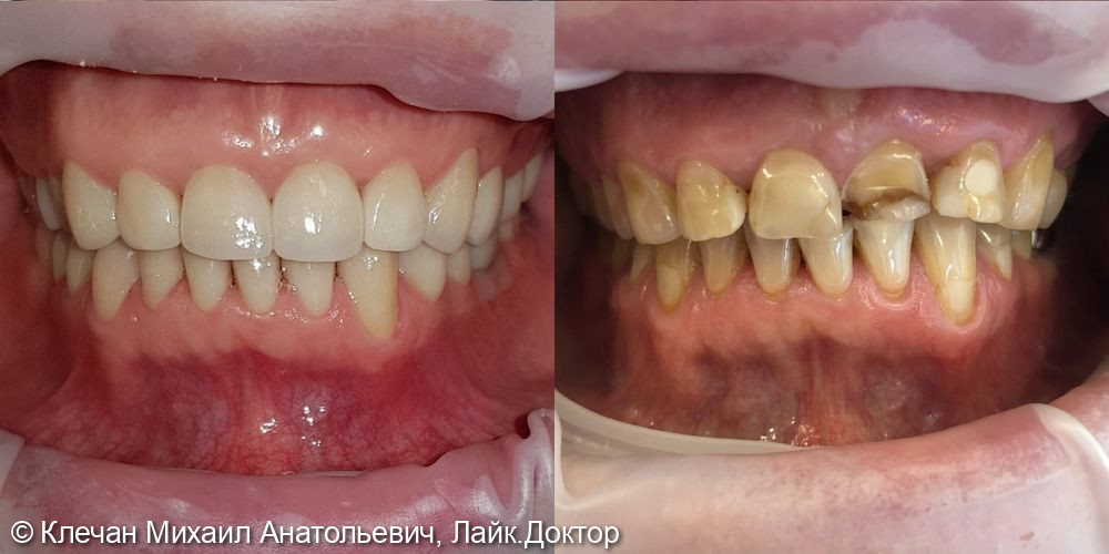Комплексное протезирование на живых зубах - фото №2