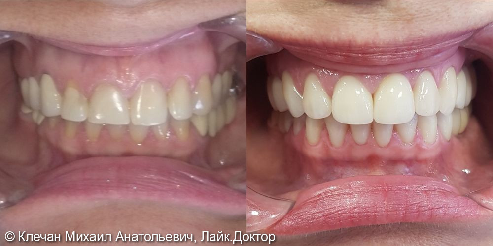 Комплексное протезирование на зубах и имплантатах циркониевыми коронками и винирами - фото №2