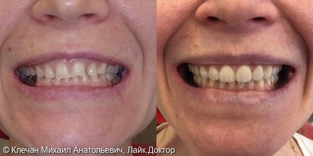 Комплексное функционально-эстетическое протезирование на живых зубах и имплантатах - фото №1