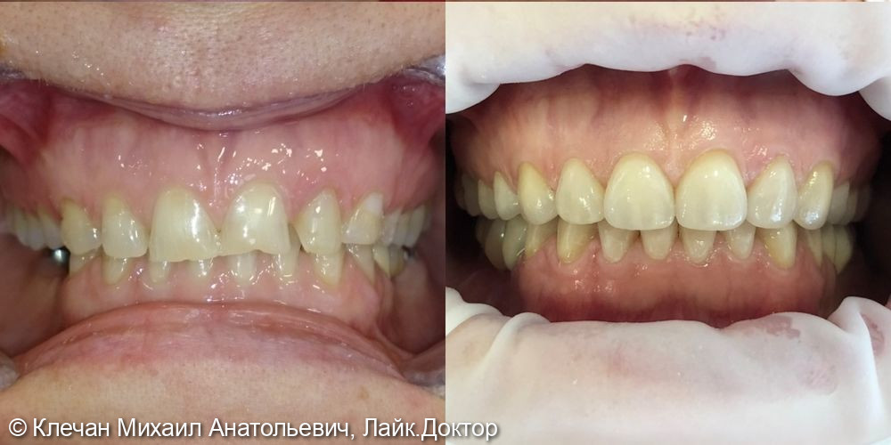 Комплексное функционально-эстетическое протезирование на живых зубах и имплантатах - фото №2