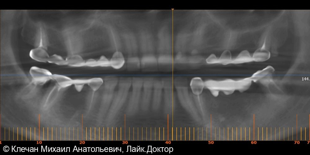 Комплексное протезирование на зубах и имплантатах циркониевыми коронками и винирами - фото №3