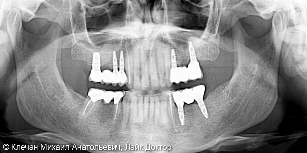 Комплексное протезирование на зубах и имплантатах циркониевыми коронками и винирами - фото №4