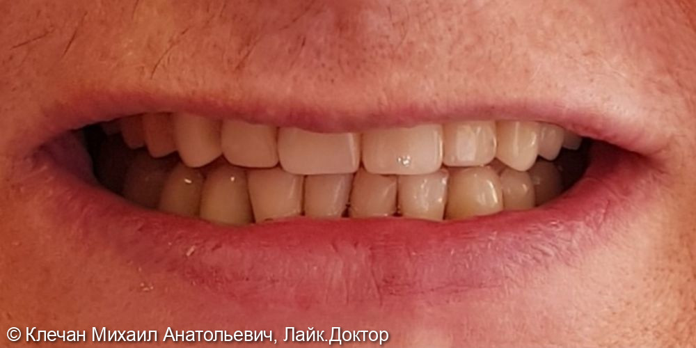 Комплексное протезирование зубов и имплантатов металлокерамическими коронками и мосовидными протезами - фото №2