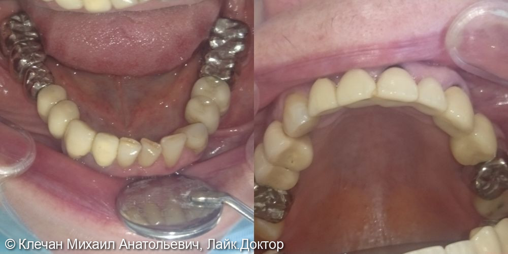 Комплексное протезирование зубов и имплантатов металлокерамическими коронками и мосовидными протезами - фото №3
