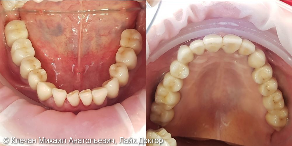 Комплексное протезирование зубов и имплантатов металлокерамическими коронками и мосовидными протезами - фото №4