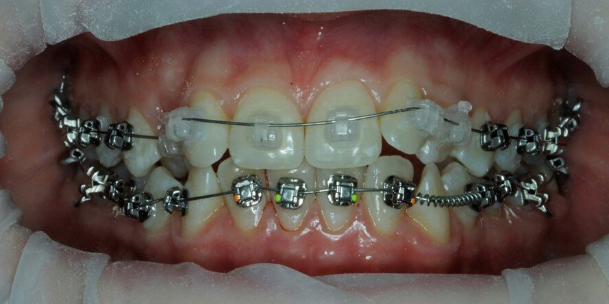 Скрученность передних зубов на верхней и нижней челюсти - фото №2