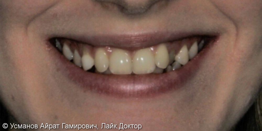 Скрученность передних зубов на верхней и нижней челюсти - фото №1