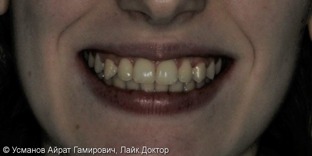 Скрученность передних зубов на верхней и нижней челюсти - фото №3