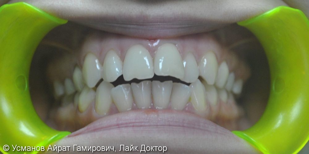 Ортодонтическое лечение с применением многопетлевой дуги, металлических самолигирующихся брекетов - фото №1