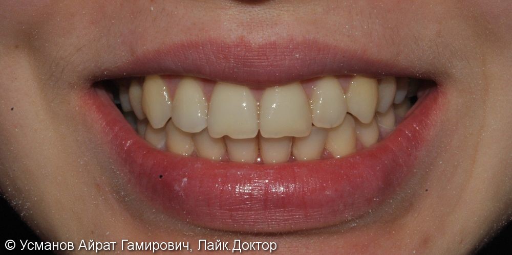 Ортодонтическое лечение с применением многопетлевой дуги, металлических самолигирующихся брекетов - фото №2