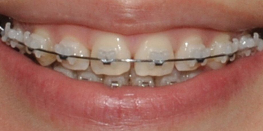 Убрали диастему между передними зубам верхней челюсти, до и после - фото №2