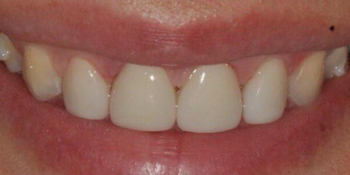 Убрали диастему между передними зубам верхней челюсти, до и после - фото №3