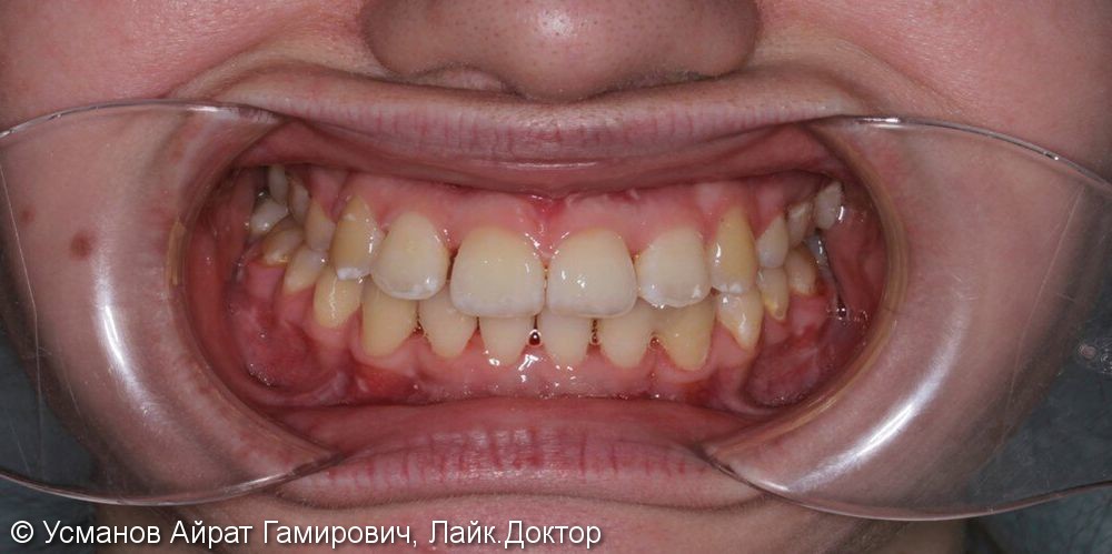 Гигиена полости рта после снятия брекетов - фото №2