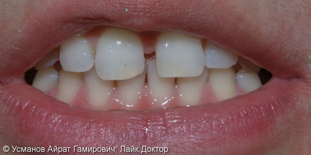 Убрали диастему между передними зубам верхней челюсти, до и после - фото №1