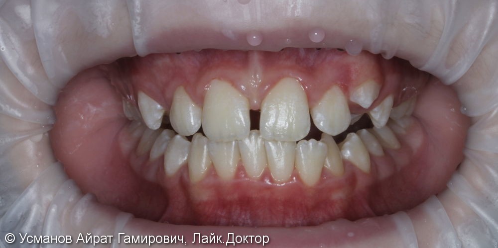 2х этапное ортодонтическое лечение, исправление диастемы - фото №1
