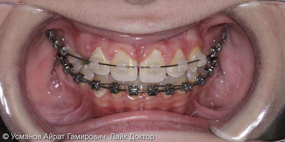 2х этапное ортодонтическое лечение, исправление диастемы - фото №3