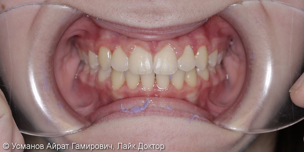 2х этапное ортодонтическое лечение, исправление диастемы - фото №4