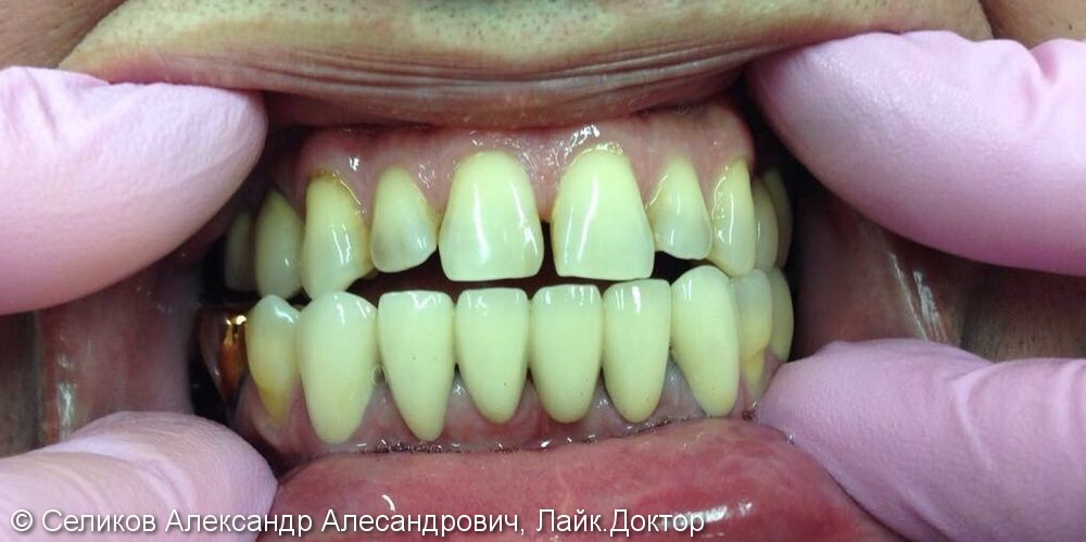 Лечение и протезирование зубов на нижней челюсти - фото №2