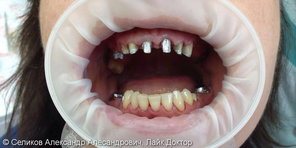 Лечение и протезирование зубов мостовидным протезом на 7 зубов - фото №1