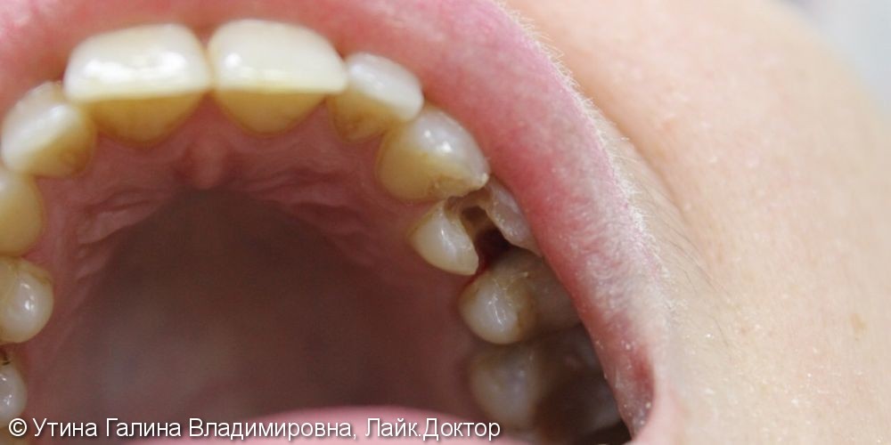 Лечение пульпита и реставрация разрушенного зуба - фото №1