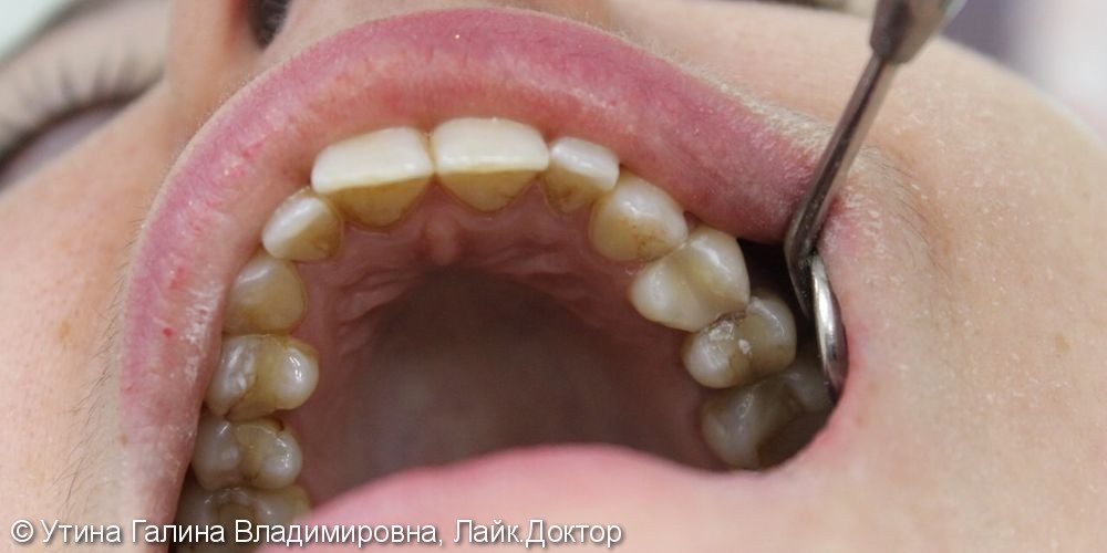 Лечение пульпита и реставрация разрушенного зуба - фото №2