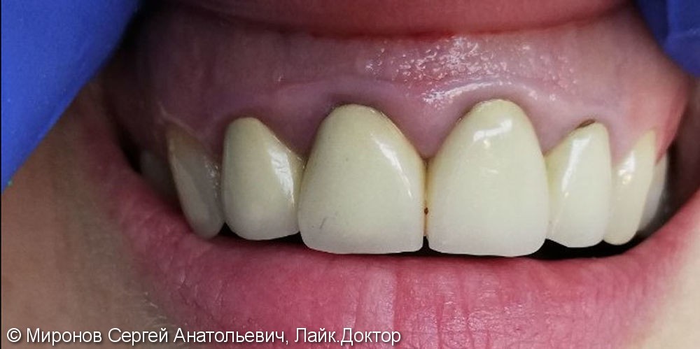 Нависание десны в зоне улыбки над передней группой зубов - фото №1
