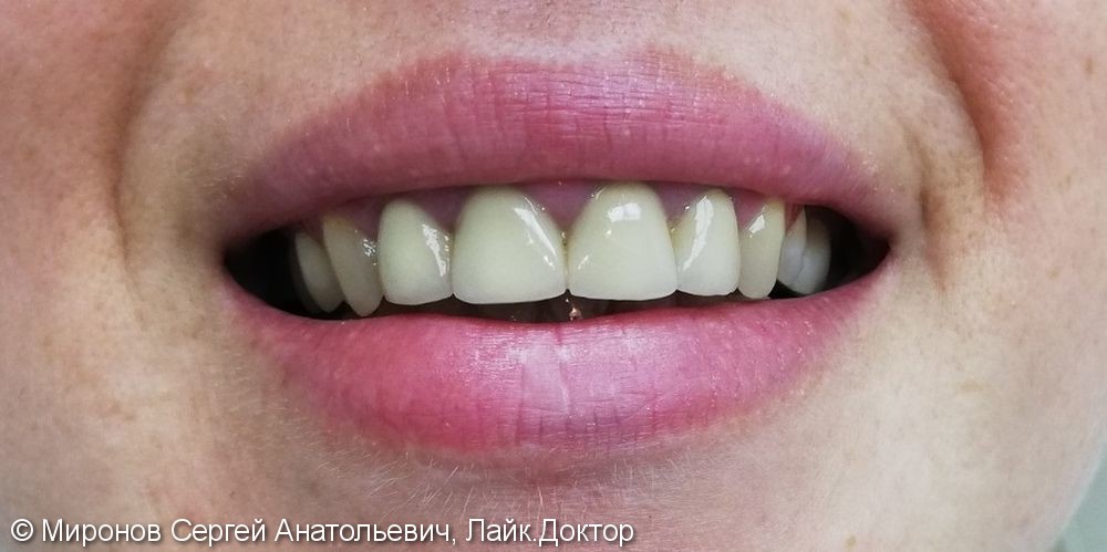 Нависание десны в зоне улыбки над передней группой зубов - фото №2