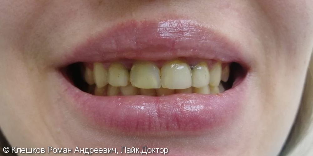 Протезирование 5 зубов металлокерамическими коронками - фото №1