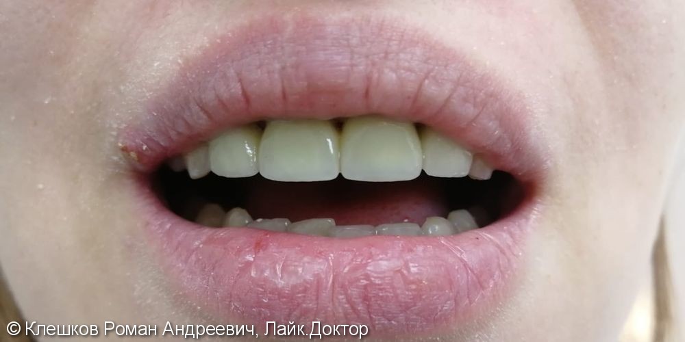 Протезирование 5 зубов металлокерамическими коронками - фото №2
