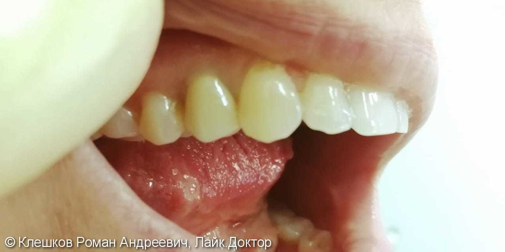Восстановление зуба штифтово-культевой вкладкой и мк коронкой - фото №2