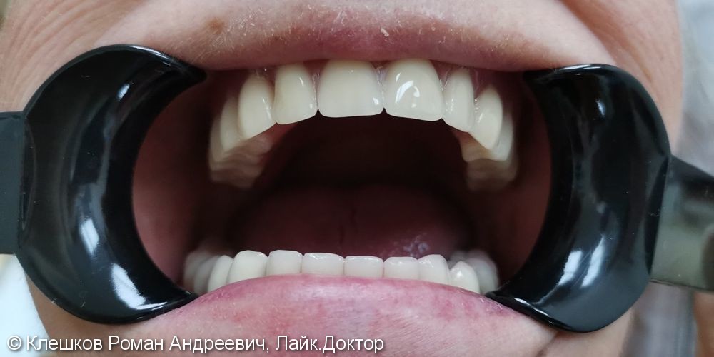 Нейлоновый протез при частичном отсутствии зубов