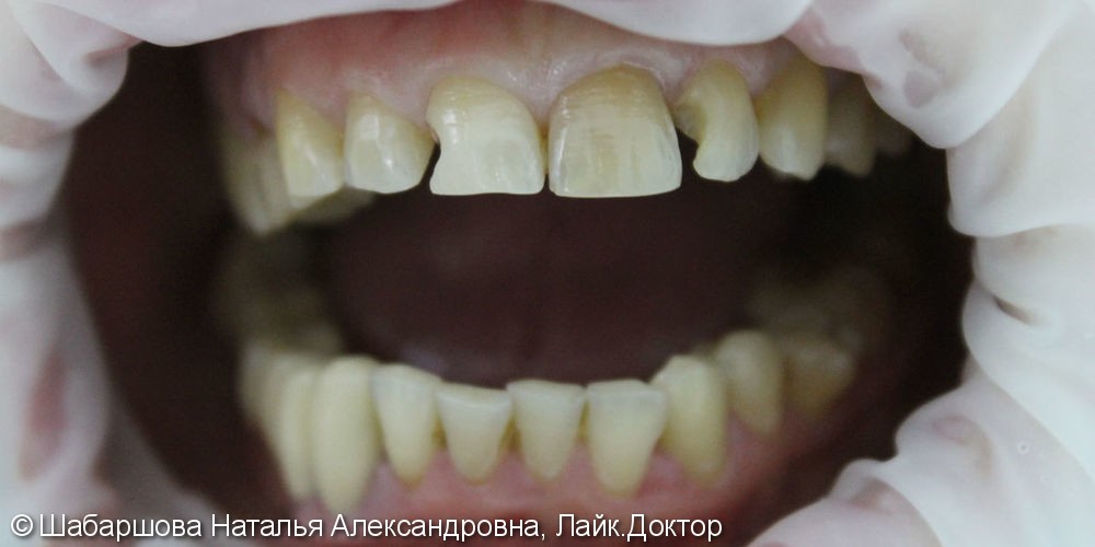 Реставрация передних зубов светоотверждаемыми композитами - фото №1