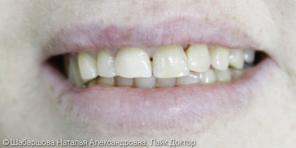 Реставрация передних зубов светоотверждаемыми композитами - фото №2