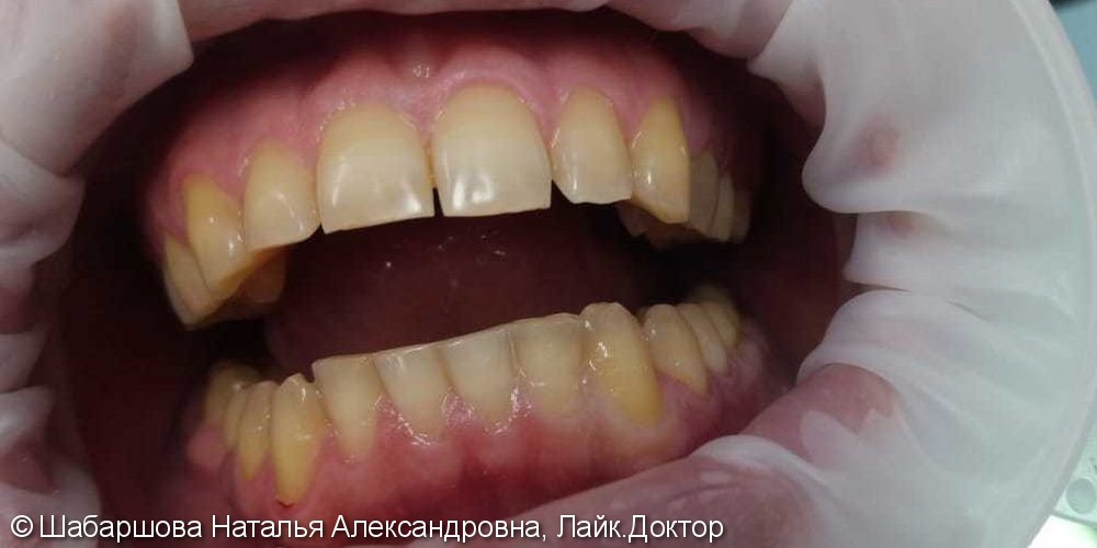 Кислородное отбеливание зубов Amazing White - фото №1