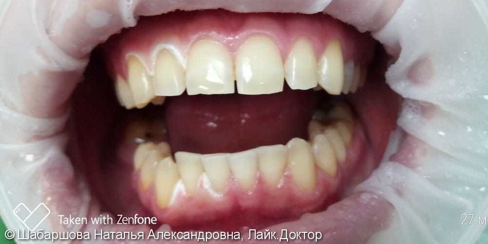 Кислородное отбеливание зубов Amazing White - фото №2