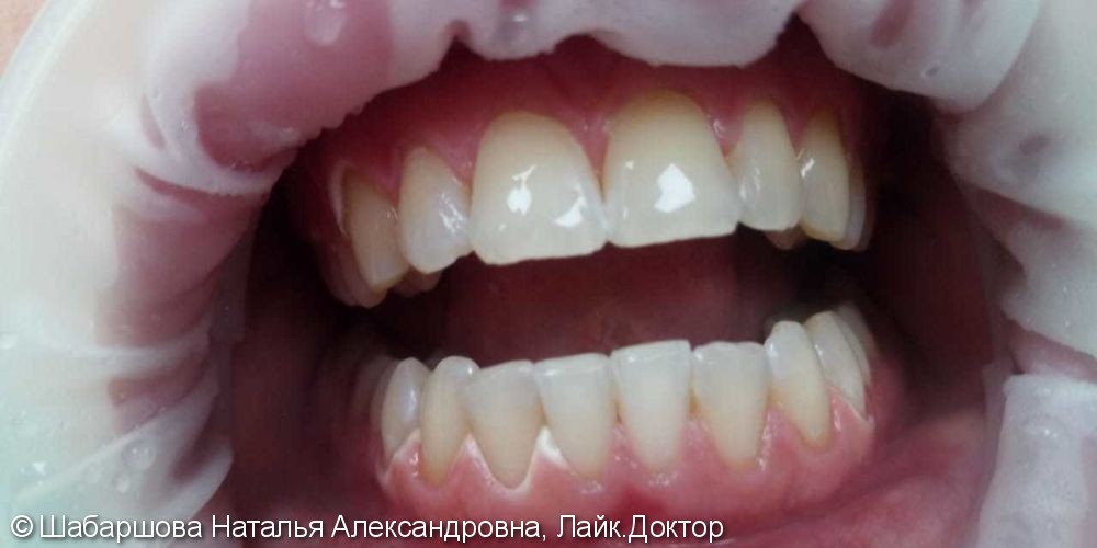 Кислородное отбеливание зубов Amazing White - фото №2