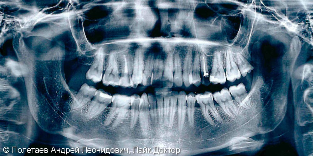 Одномоментная имплантация со сложным удалением зуба и костной пластикой - фото №1