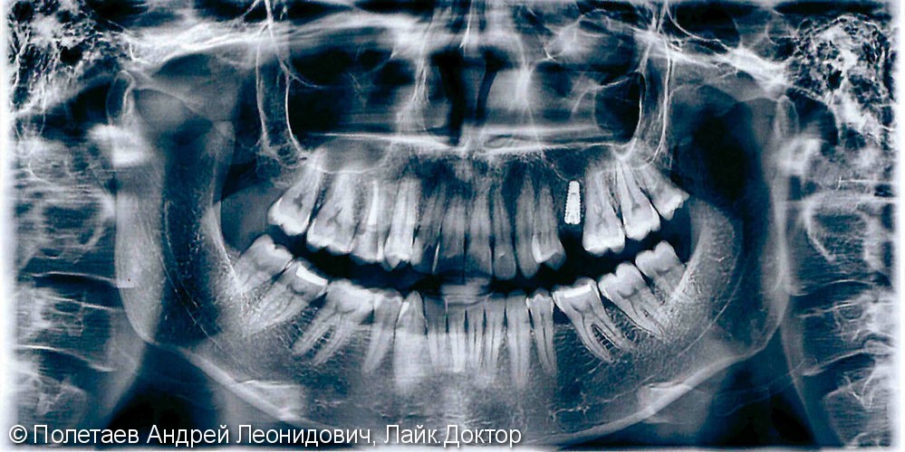 Одномоментная имплантация со сложным удалением зуба и костной пластикой - фото №4