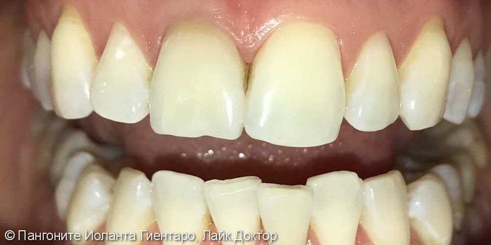 Кислородное отбеливание зубов - фото №2