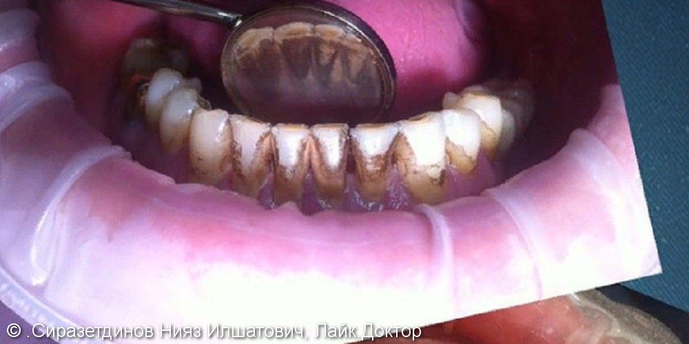 Профессиональная гигиена зубов, удаление пигментного налета, до и после - фото №1
