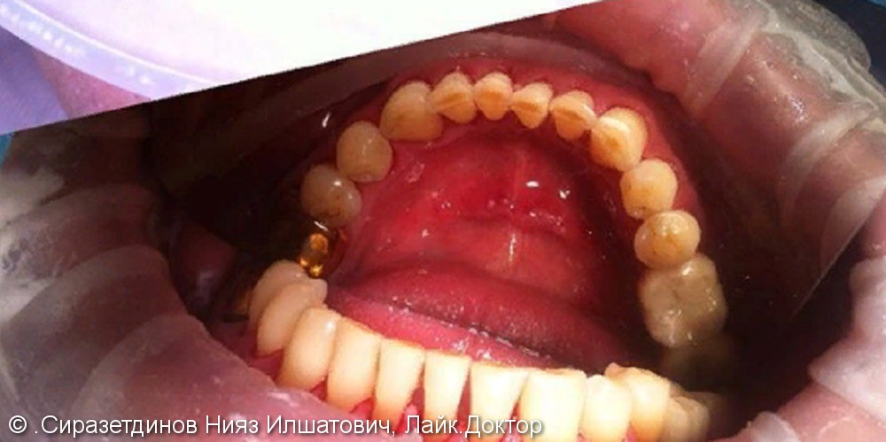 Профессиональная гигиена зубов, удаление пигментного налета, до и после - фото №2