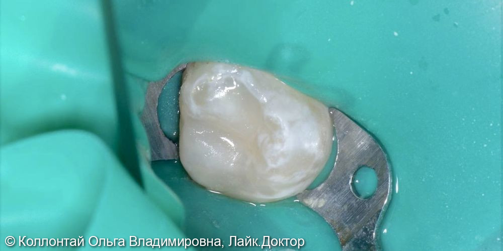 Лечение кариеса зуба 2.7 - фото №2